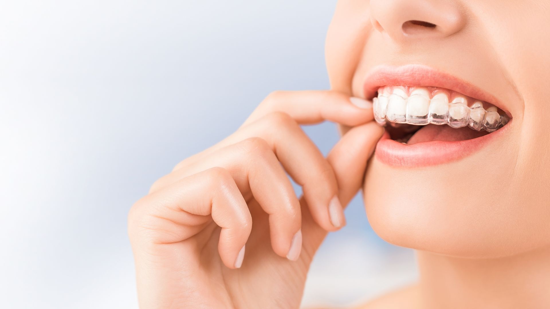 ORTODONCIA CONVENCIONAL E INVISALIGN
